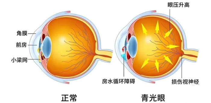 科普 | 人类致盲的“隐形杀手”——青光眼
