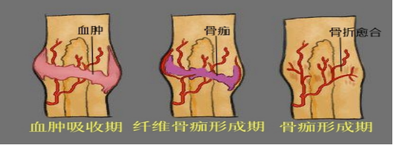 科普 | “伤筋动骨一百天”是迷信吗？