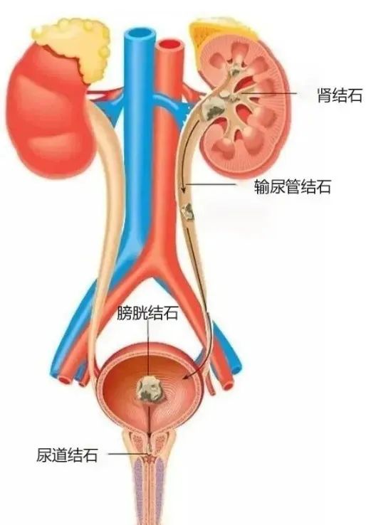 科普 | 关爱泌尿系统，警惕泌尿系结石