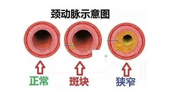 健康科普 | 头晕、记忆力下降？可能是颈动脉斑块在报警 融安人医 2025年06月18日 19:00 广西